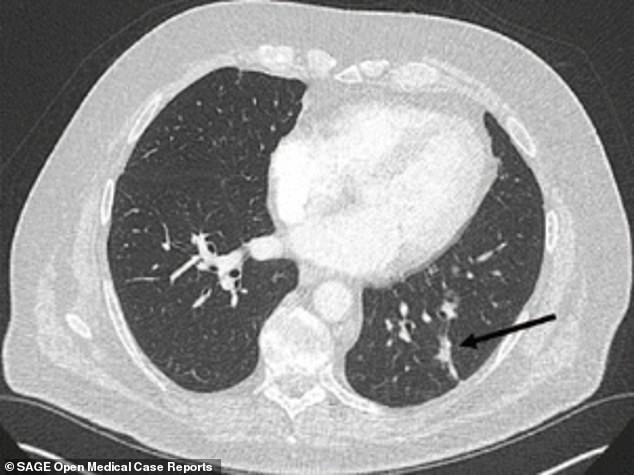 Lung Cancer Patient's Tumors Shrunk in Half After Using CBD Oil 10464374-6761503-Instead_the_ex_smoker_believed_to_be_from_the_Stoke_on_Trent_are-a-10_1551459543186