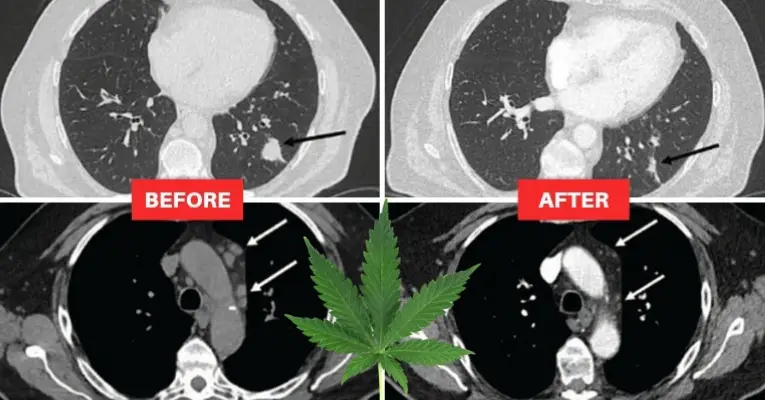 Lung Cancer Patient's Tumors Shrunk in Half After Using CBD Oil Cancer-cbd-oil