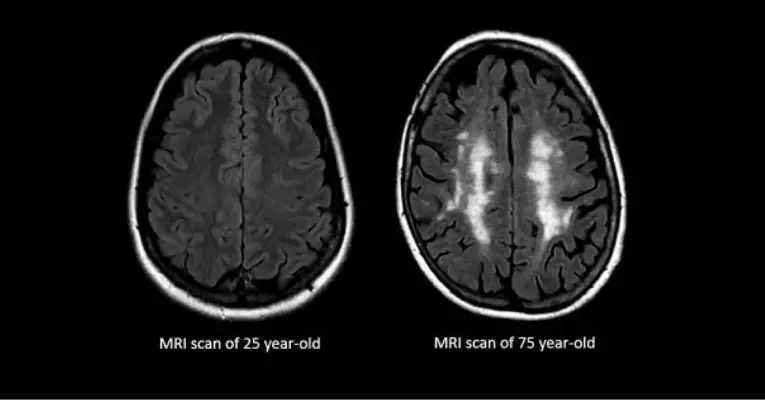 Scientists Prevent Brain Aging
