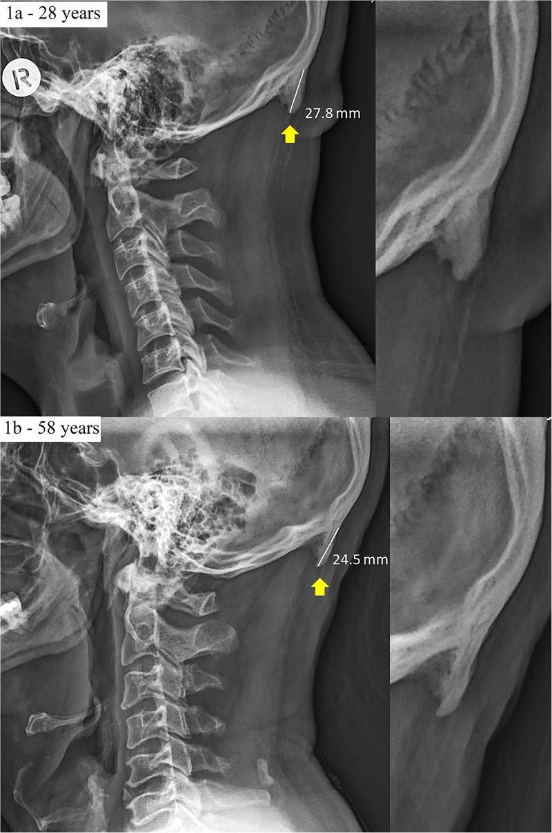 We’ve Started Growing Spikes in the Back of Our Skulls Because We Use