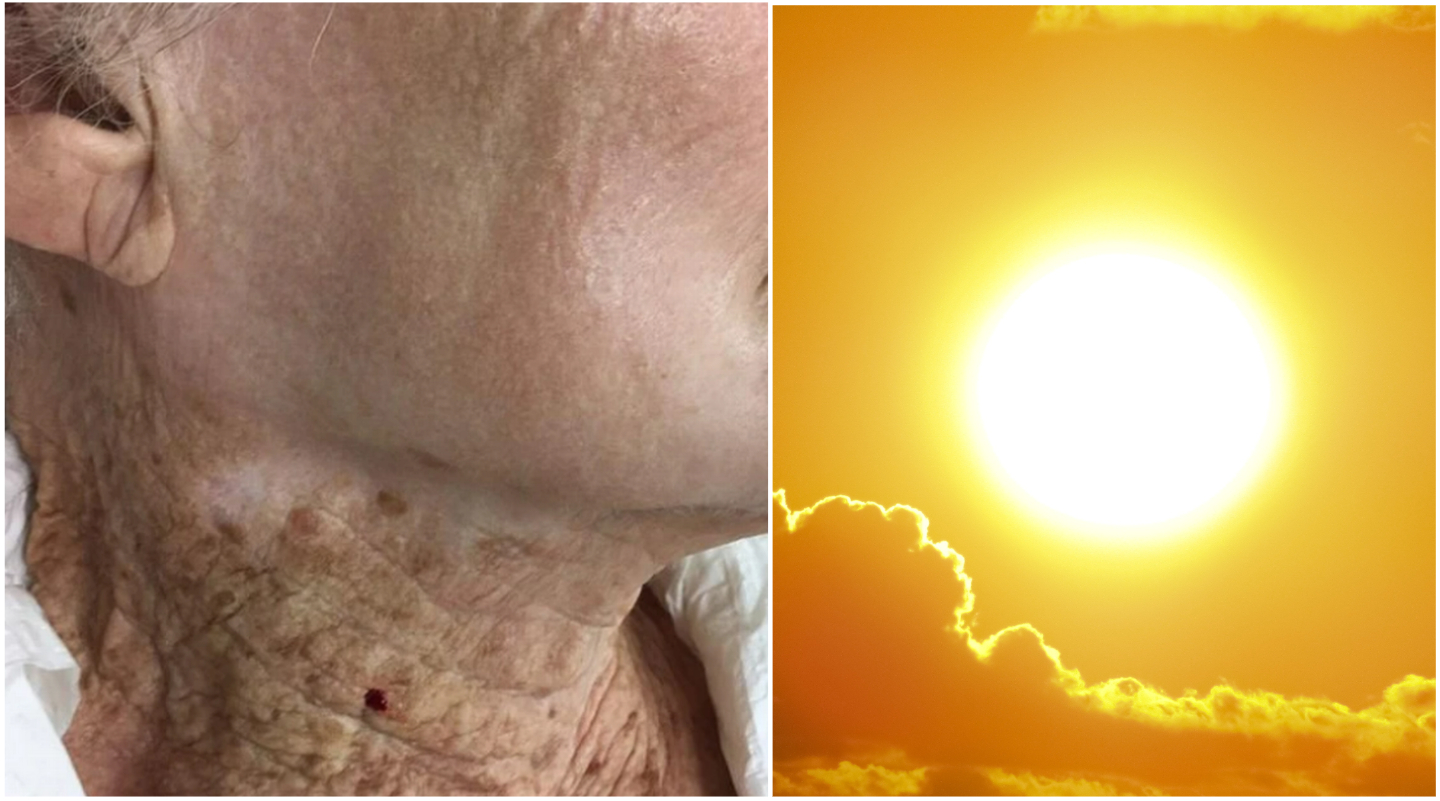 This Woman Wore Sunscreen On Her Face But Not Neck For 40 Years, And This Is The Result
